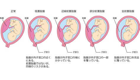 胎盤鉗|Q14．前置胎盤・低置胎盤で出血が多い際の対応は？